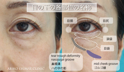 目の下の涙袋・目袋など各名称について | 目の下のクマ・たるみ治療検討お役立ちブログ