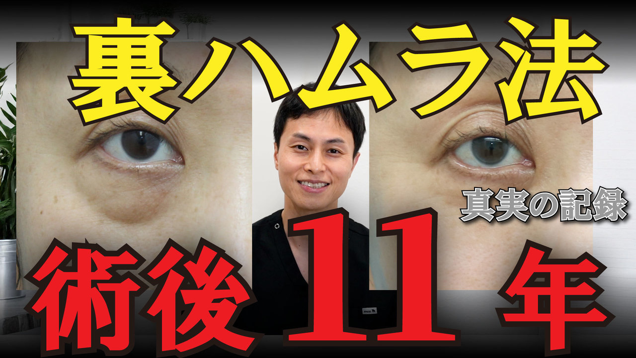 裏ハムラ法　術後11年