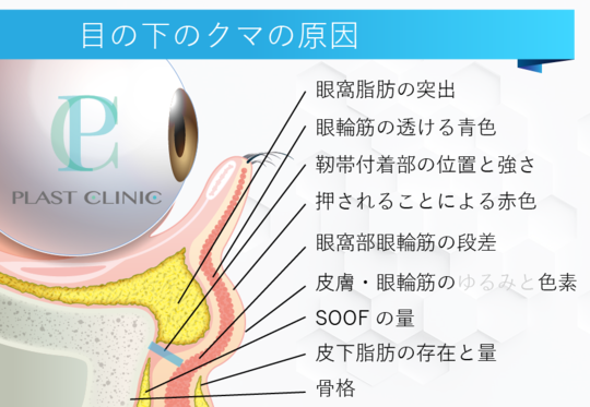 目の下のクマ たるみの原因 目の下のクマ たるみ治療検討お役立ちブログ 運営 プラストクリニック 東京