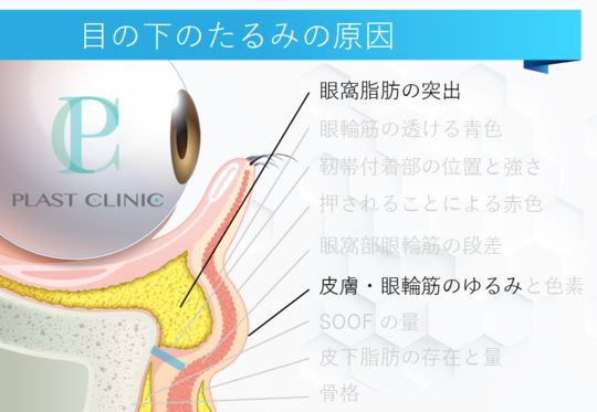 目の下のクマ たるみの原因 目の下のクマ たるみ治療検討お役立ちブログ 運営 プラストクリニック 東京