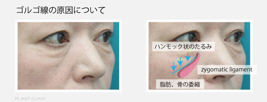 ゴルゴ線の原因
