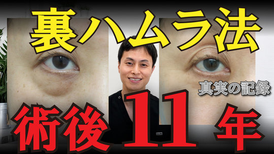 裏ハムラ法　術後11年