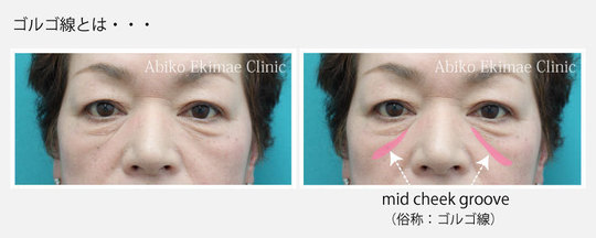 ゴルゴ線 ゴルゴライン の治療について 目の下のクマ たるみ治療検討お役立ちブログ ゴルゴ線 ゴルゴライン の治療について 目の下のクマ たるみ治療検討お役立ちブログ